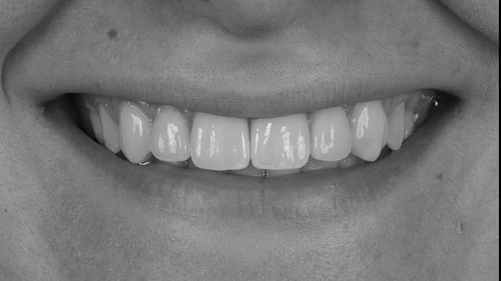 tooth after