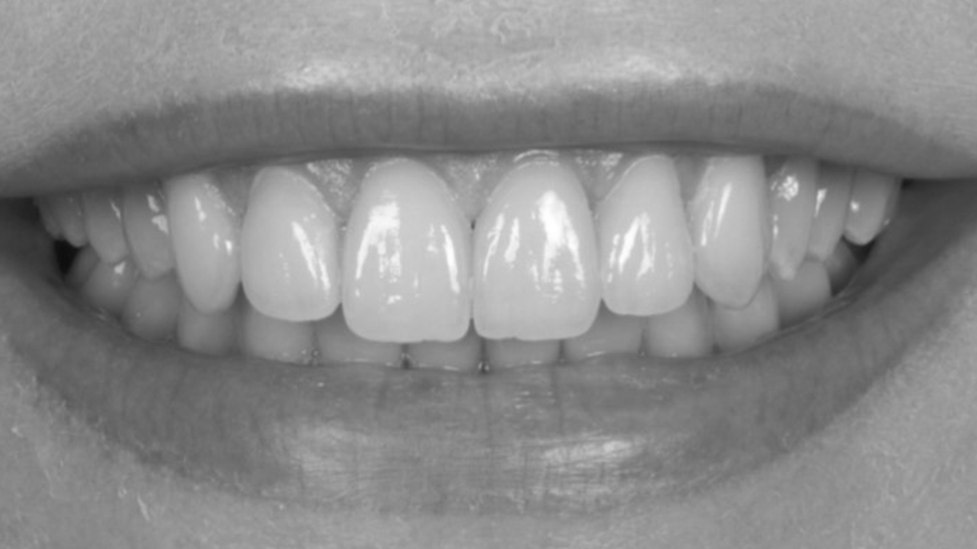 tooth after