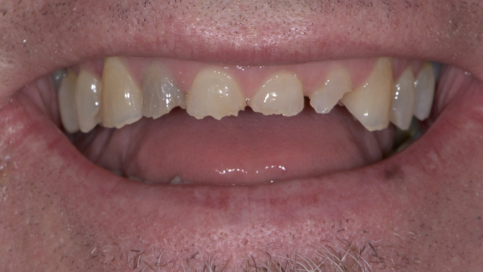 Massive loss of hard tissue