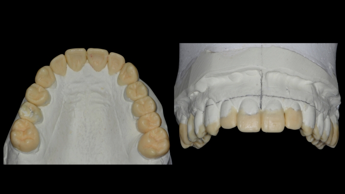 Maxillary Waxup