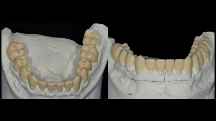 Mandibular Waxup