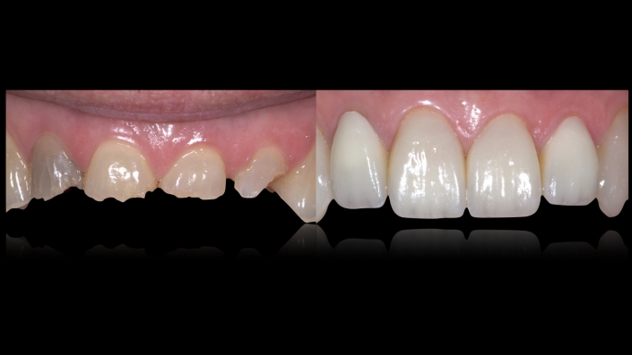 Maxillary Anteriores