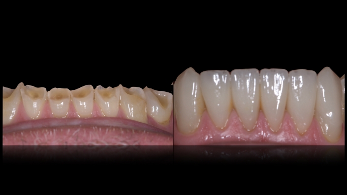 Mandibular Anteriores