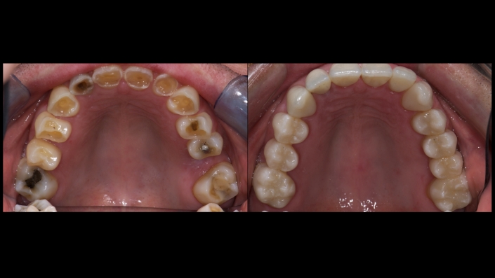 Maxillary Arch