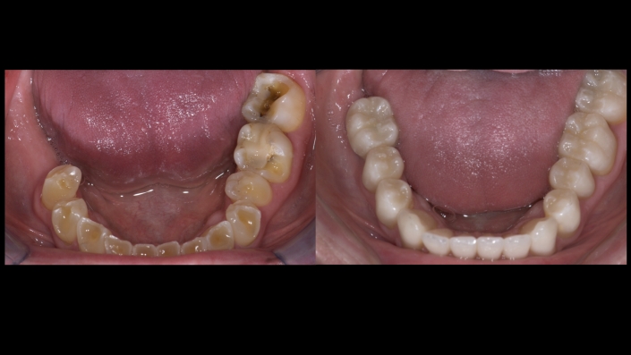 Mandibular Arch