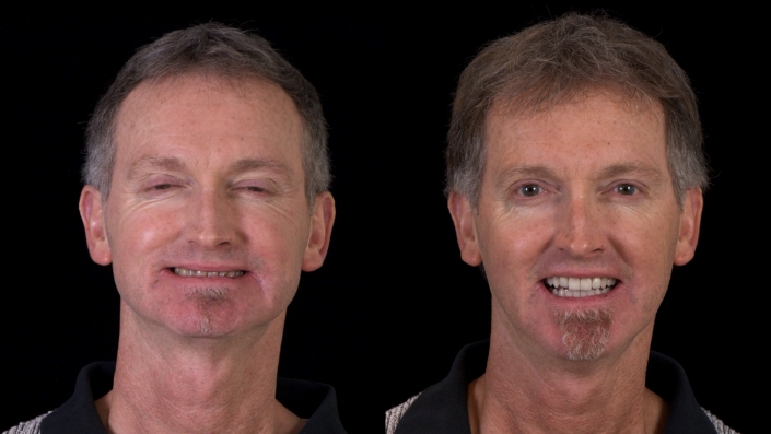 Before vs After